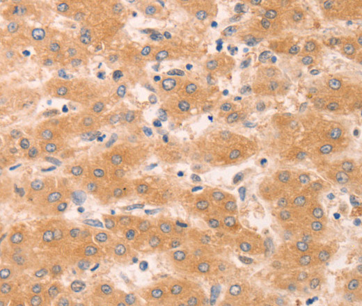 Immunohistochemistry of paraffin-embedded Human liver cancer using GNA11 Polyclonal Antibody at dilution of 1:40