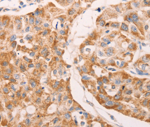 Immunohistochemistry of paraffin-embedded Human lung cancer using GNA11 Polyclonal Antibody at dilution of 1:40