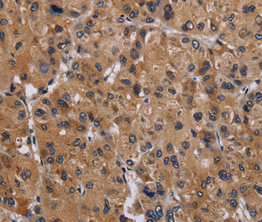 Immunohistochemistry of paraffin-embedded Human liver cancer using GNAS Polyclonal Antibody at dilution of 1:30