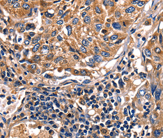 Immunohistochemistry of paraffin-embedded Human lung cancer tissue using Galectin 8 Polyclonal Antibody at dilution 1:50