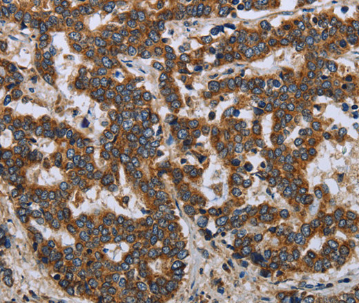 Immunohistochemistry of paraffin-embedded Human liver cancer tissue using LGALS2 Polyclonal Antibody at dilution 1:30