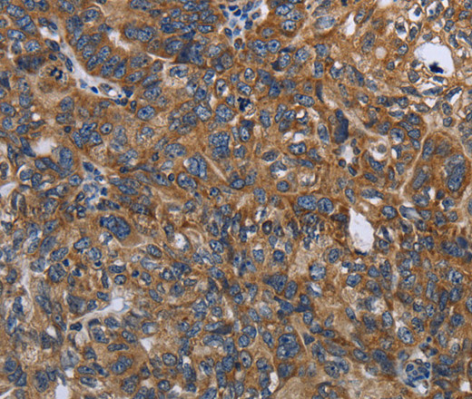 Immunohistochemistry of paraffin-embedded Human ovarian cancer tissue using LGALS2 Polyclonal Antibody at dilution 1:30