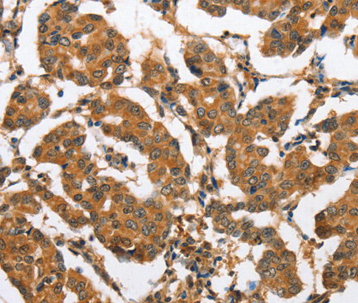 Immunohistochemistry of paraffin-embedded Human breast cancer tissue using CXCL14 Polyclonal Antibody at dilution 1:60