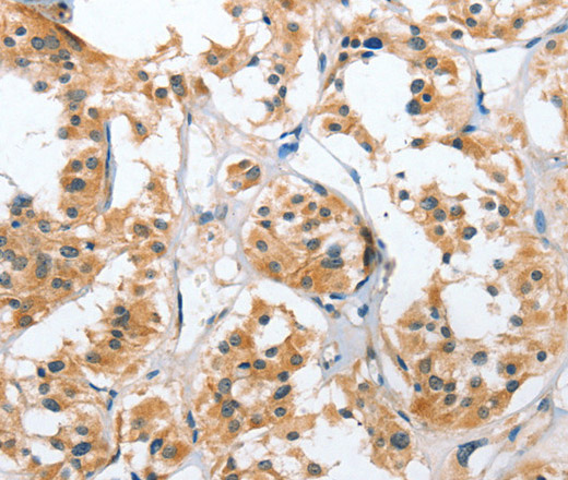 Immunohistochemistry of paraffin-embedded Human thyroid cancer tissue using UGCG Polyclonal Antibody at dilution 1:50
