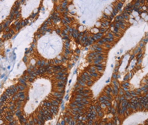 Immunohistochemistry of paraffin-embedded Human colon cancer using GPA33 Polyclonal Antibody at dilution of 1:30