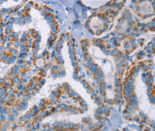 Immunohistochemistry of paraffin-embedded Human thyroid cancer using GPA33 Polyclonal Antibody at dilution of 1:30