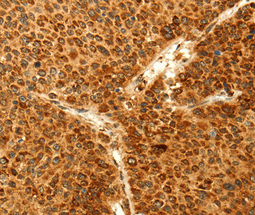 Immunohistochemistry of paraffin-embedded Human liver cancer tissue using GRM3 Polyclonal Antibody at dilution 1:50