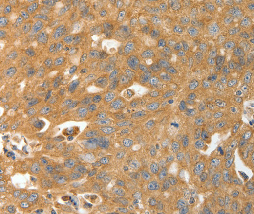 Immunohistochemistry of paraffin-embedded Human ovarian cancer using CALR Polyclonal Antibody at dilution of 1:30