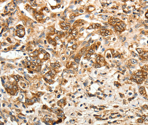 Immunohistochemistry of paraffin-embedded Human gastric cancer using CALR Polyclonal Antibody at dilution of 1:30