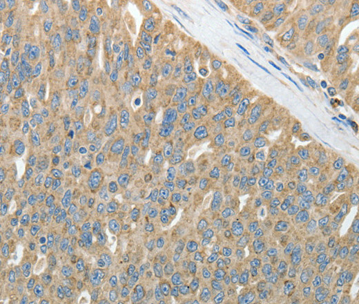 Immunohistochemistry of paraffin-embedded Human ovarian cancer using HSP90B1 Polyclonal Antibody at dilution of 1:50