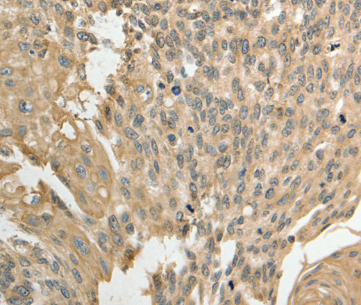 Immunohistochemistry of paraffin-embedded Human cervical cancer using GSR Polyclonal Antibody at dilution of 1:50