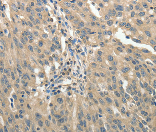 Immunohistochemistry of paraffin-embedded Human ovarian cancer using GSR Polyclonal Antibody at dilution of 1:50