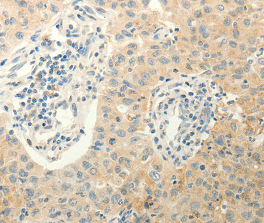 Immunohistochemistry of paraffin-embedded Human lung cancer using ERG Polyclonal Antibody at dilution of 1:40