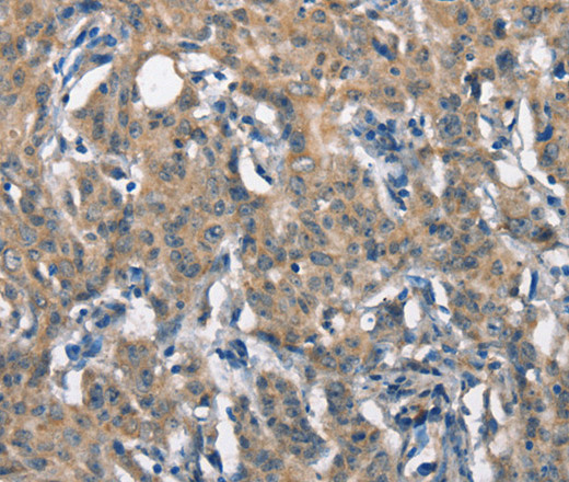 Immunohistochemistry of paraffin-embedded Human gastric cancer tissue using SCARB1 Polyclonal Antibody at dilution 1:65