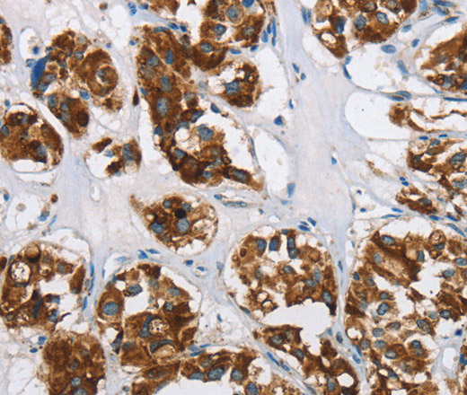 Immunohistochemistry of paraffin-embedded Human thyroid cancer using HINT2 Polyclonal Antibody at dilution of 1:50