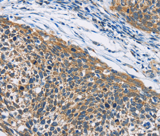 Immunohistochemistry of paraffin-embedded Human cervical cancer tissue using HDAC6 Polyclonal Antibody at dilution 1:50