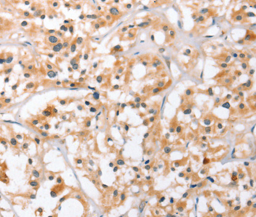 Immunohistochemistry of paraffin-embedded Human thyroid cancer using HDAC8 Polyclonal Antibody at dilution of 1:40