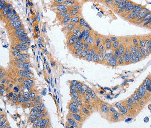 Immunohistochemistry of paraffin-embedded Human colon cancer tissue using HSPA1A Polyclonal Antibody at dilution 1:40