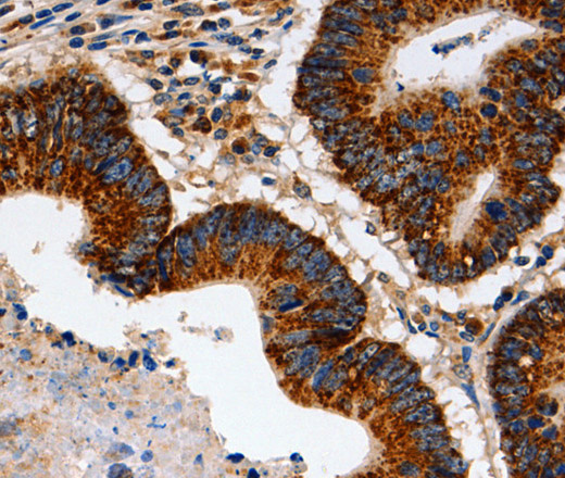 Immunohistochemistry of paraffin-embedded Human colon cancer using HSP75 Polyclonal Antibody at dilution of 1:60