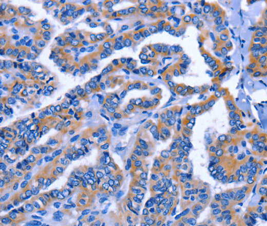 Immunohistochemistry of paraffin-embedded Human thyroid cancer tissue using IGSF10 Polyclonal Antibody at dilution 1:60