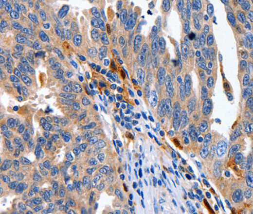 Immunohistochemistry of paraffin-embedded Human ovarian cancer using IL18 Polyclonal Antibody at dilution of 1:100