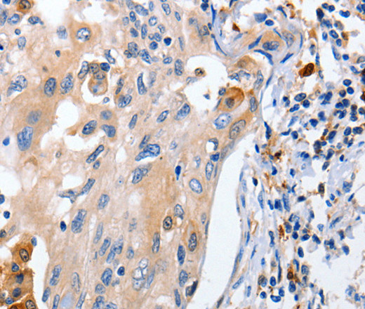 Immunohistochemistry of paraffin-embedded Human cervical cancer using IL18 Polyclonal Antibody at dilution of 1:100