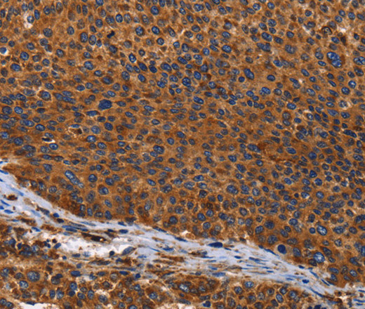 Immunohistochemistry of paraffin-embedded Human liver cancer using ILK Polyclonal Antibody at dilution of 1:60