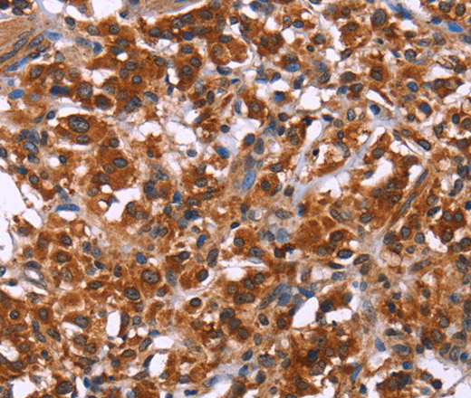 Immunohistochemistry of paraffin-embedded Human thyroid cancer using ING2 Polyclonal Antibody at dilution of 1:40