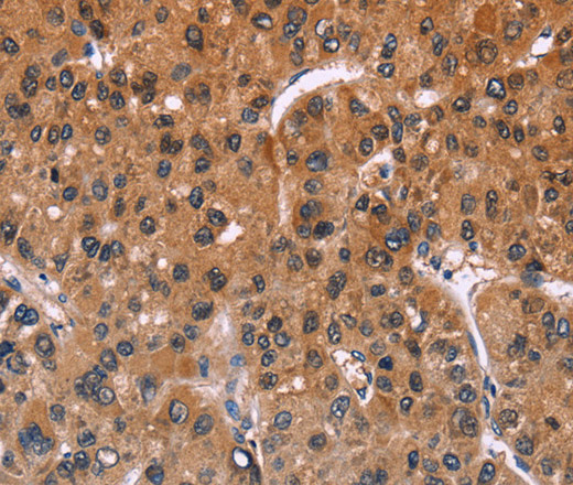 Immunohistochemistry of paraffin-embedded Human liver cancer using ING2 Polyclonal Antibody at dilution of 1:40