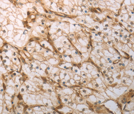 Immunohistochemistry of paraffin-embedded Human renal cancer tissue using INHA Polyclonal Antibody at dilution 1:150