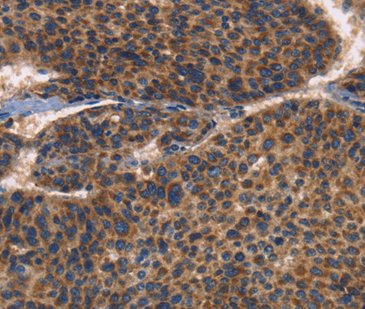 Immunohistochemistry of paraffin-embedded Human liver cancer using CD61 Polyclonal Antibody at dilution of 1:30