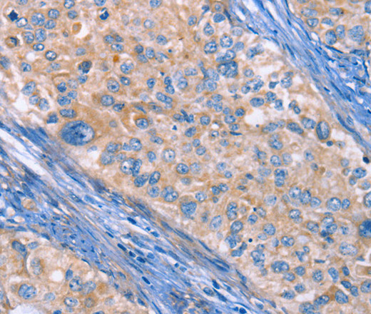 Immunohistochemistry of paraffin-embedded Human cervical cancer using CD61 Polyclonal Antibody at dilution of 1:30