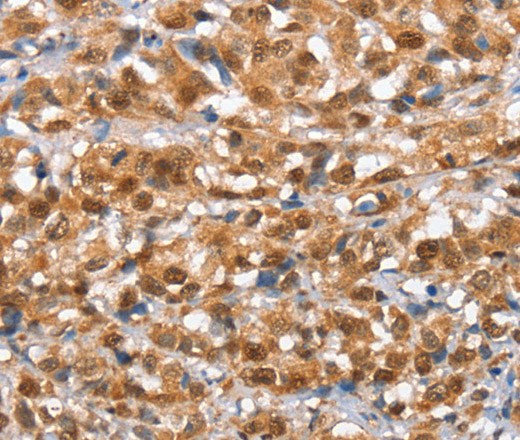 Immunohistochemistry of paraffin-embedded Human esophagus cancer tissue using IRAK3 Polyclonal Antibody at dilution 1:50