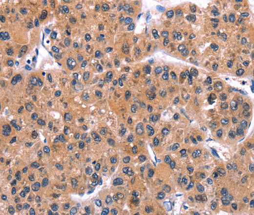 Immunohistochemistry of paraffin-embedded Human liver cancer tissue using IRS1 Polyclonal Antibody at dilution 1:30