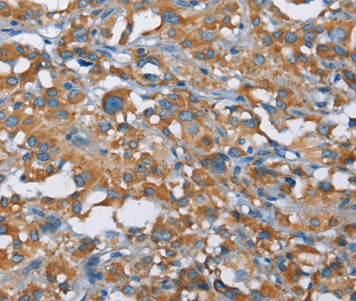 Immunohistochemistry of paraffin-embedded Human thyroid cancer tissue using KLF7 Polyclonal Antibody at dilution 1:40