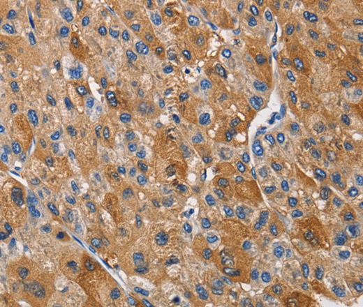 Immunohistochemistry of paraffin-embedded Human liver cancer tissue using KLK1 Polyclonal Antibody at dilution 1:40