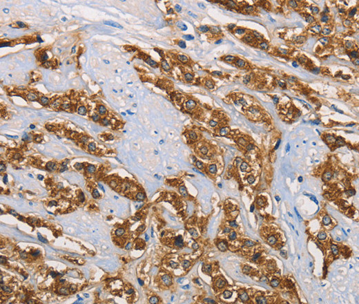 Immunohistochemistry of paraffin-embedded Human prostate cancer tissue using KLK1 Polyclonal Antibody at dilution 1:40