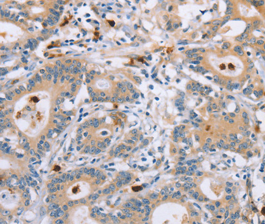 Immunohistochemistry of paraffin-embedded Human colon cancer tissue using KLK4 Polyclonal Antibody at dilution 1:40