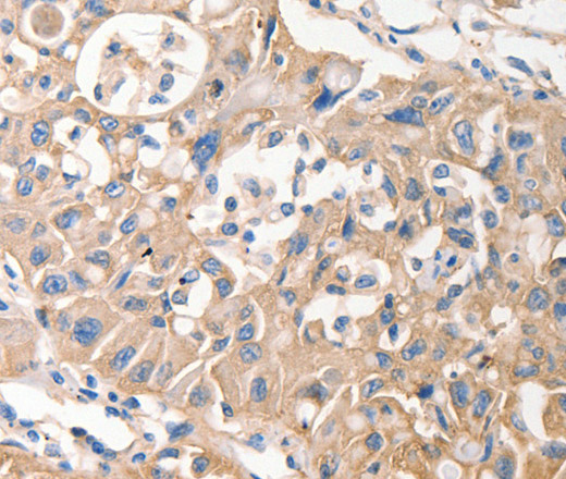 Immunohistochemistry of paraffin-embedded Human lung cancer using MVP Polyclonal Antibody at dilution of 1:40