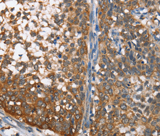 Immunohistochemistry of paraffin-embedded Human cervical cancer using MAD2L1BP Polyclonal Antibody at dilution of 1:65