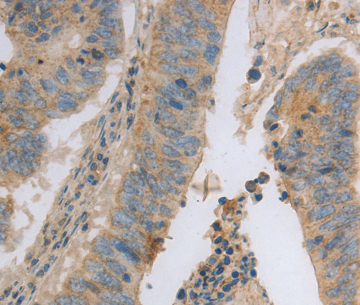 Immunohistochemistry of paraffin-embedded Human colon cancer using MAGED1 Polyclonal Antibody at dilution of 1:30