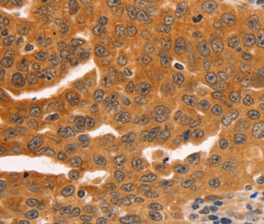 Immunohistochemistry of paraffin-embedded Human ovarian cancer using SERPINB5 Polyclonal Antibody at dilution of 1:60