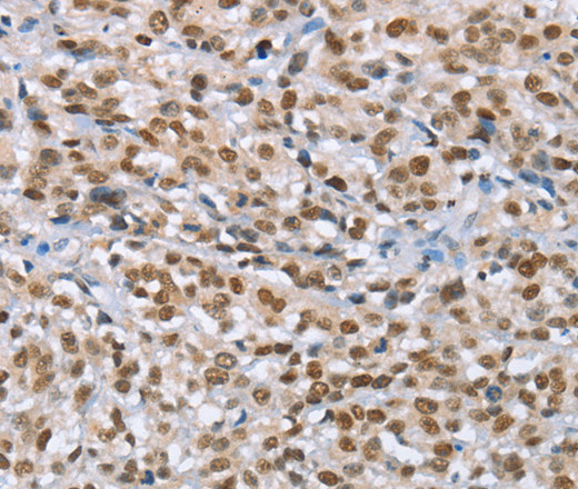 Immunohistochemistry of paraffin-embedded Human esophagus cancer using MCM6 Polyclonal Antibody at dilution of 1:60