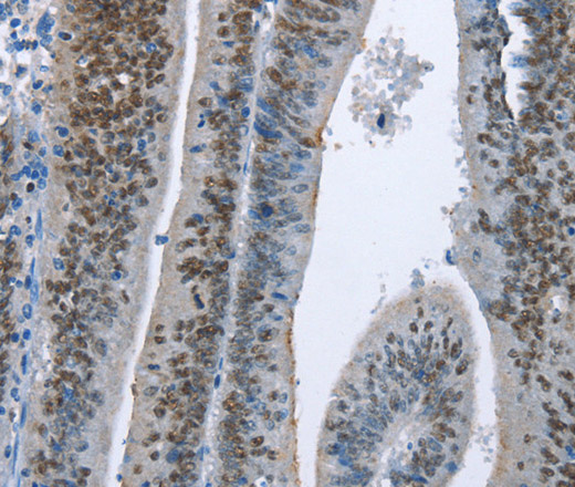 Immunohistochemistry of paraffin-embedded Human colon cancer using MCM6 Polyclonal Antibody at dilution of 1:60