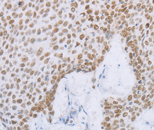 Immunohistochemistry of paraffin-embedded Human lung cancer tissue using MCM2 Polyclonal Antibody at dilution 1:50