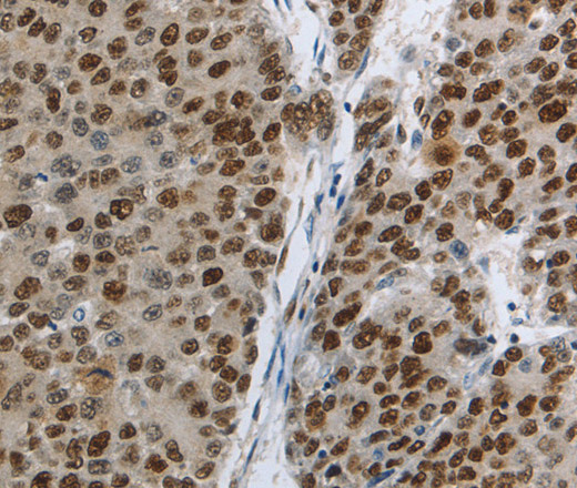 Immunohistochemistry of paraffin-embedded Human liver cancer using MCM3 Polyclonal Antibody at dilution of 1:30