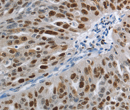 Immunohistochemistry of paraffin-embedded Human ovarian cancer using MCM3 Polyclonal Antibody at dilution of 1:30