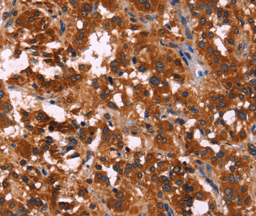 Immunohistochemistry of paraffin-embedded Human thyroid cancer using RPSA Polyclonal Antibody at dilution of 1:60