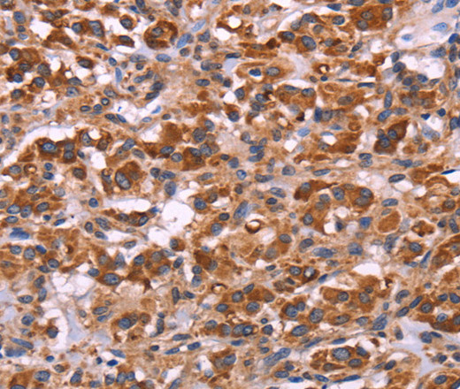 Immunohistochemistry of paraffin-embedded Human thyroid cancer tissue using MMP14 Polyclonal Antibody at dilution 1:40