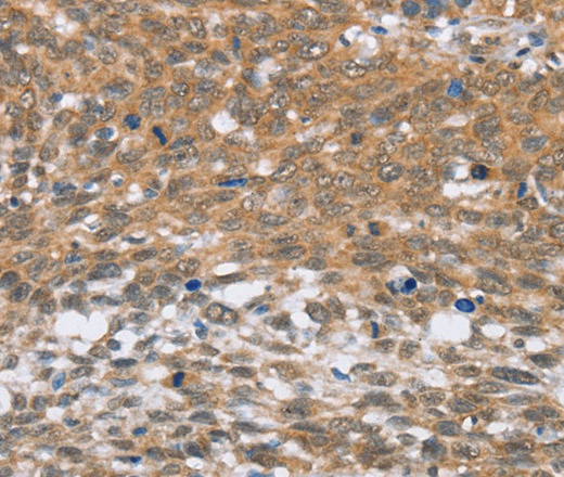 Immunohistochemistry of paraffin-embedded Human cervical cancer tissue using MLH1 Polyclonal Antibody at dilution 1:60